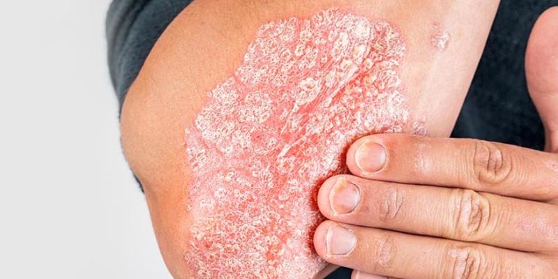 Bệnh vảy nến kiêng ăn gì?
