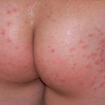 Tổn thương trên da mông do hắc lào gây ra có hình dáng tương tự đồng xu