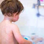 Tìm hiểu bị mề đay tắm lá gì để có kế hoạch chăm sóc và bảo vệ da phù hợp