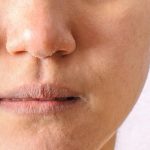 Bệnh chàm khô có thể bùng phát triệu chứng ở mọi vị trí trên cơ thể
