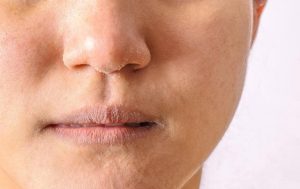 Bệnh chàm khô có thể bùng phát triệu chứng ở mọi vị trí trên cơ thể