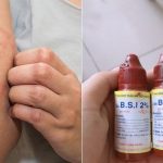 Dùng cồn chữa hắc lào thường chỉ hiệu quả trong những trường hợp bệnh nhẹ.