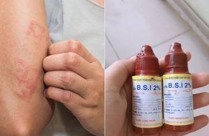Dùng cồn chữa hắc lào thường chỉ hiệu quả trong những trường hợp bệnh nhẹ.
