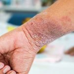 Giảm ngứa chàm ở cổ tay bằng cách nào?