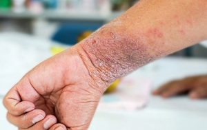 Giảm ngứa chàm ở cổ tay bằng cách nào?