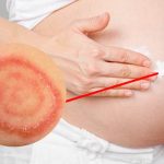 Lác đồng tiền là bệnh lý dễ xảy ra ở thai phụ do sự tấn công gây hại của vi nấm cạn