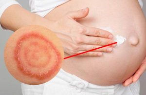 Lác đồng tiền là bệnh lý dễ xảy ra ở thai phụ do sự tấn công gây hại của vi nấm cạn
