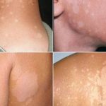Lang ben biểu hiện bằng các mảng da đổi màu, có vảy và ngứa