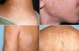 Lang ben biểu hiện bằng các mảng da đổi màu, có vảy và ngứa