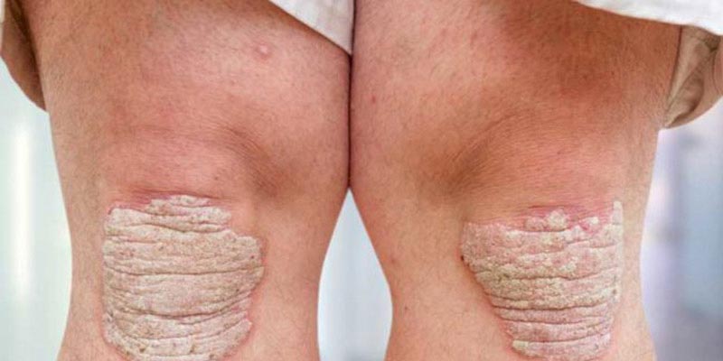 13 cách trị vảy nến bằng phương pháp dân gian hiệu quả