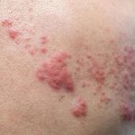 Chàm bội nhiễm là tình trạng da bị chàm bị nhiễm trùng do vi khuẩn, virus hoặc nấm