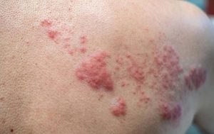 Chàm bội nhiễm là tình trạng da bị chàm bị nhiễm trùng do vi khuẩn, virus hoặc nấm