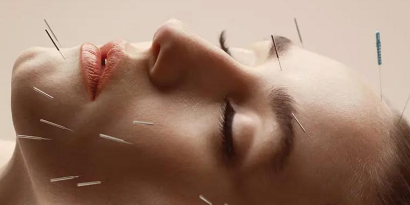 Châm cứu chữa mất ngủ là gì?