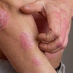 Chàm dị ứng là bệnh lý viêm da mãn tính