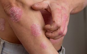 Chàm dị ứng là bệnh lý viêm da mãn tính