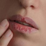 Chàm môi là bệnh lý mãn tính thường kéo dài dai dẳng và dễ tái phát