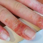 Chàm móng tay xảy ra khi người bệnh tiếp xúc với chất gây dị ứng trong thời gian dài