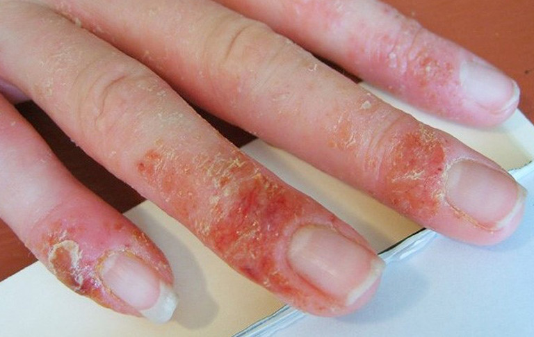 Chàm móng tay xảy ra khi người bệnh tiếp xúc với chất gây dị ứng trong thời gian dài