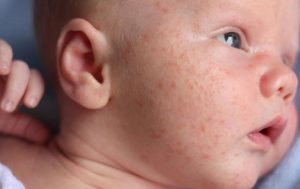 Chàm sữa là một dạng bệnh viêm da dị ứng thường gặp ở trẻ