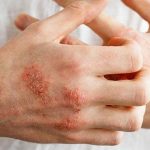 Chàm thể tạng là một trong những thể bệnh khá thường gặp của bệnh chàm