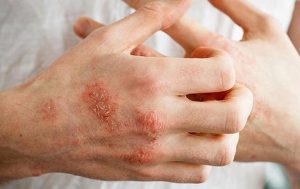 Chàm thể tạng là một trong những thể bệnh khá thường gặp của bệnh chàm