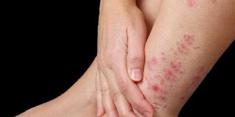Chữa tổ đỉa cho bà bầu bằng phương pháp Tây y