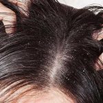Á sừng có thể gây ngứa da đầu, đỏ, viêm, khô ráp, tróc vảy và nứt nẻ