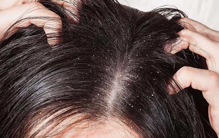 Á sừng có thể gây ngứa da đầu, đỏ, viêm, khô ráp, tróc vảy và nứt nẻ