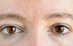 Da mặt khô tróc vảy là tình trạng da bị mất nước dẫn đến khô ráp