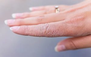 Cháy nắng là một trong những nguyên nhân khiến da khô, sạm đen và bong tróc