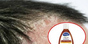 Tiêu chí lựa chọn dầu gội trị vảy nến da đầu