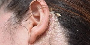 Các loại dầu gội trị viêm da tiết bã phổ biến hiện nay