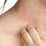 Dị ứng cơ địa xảy ra phổ biến ở Việt Nam