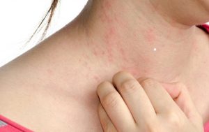 Dị ứng cơ địa xảy ra phổ biến ở Việt Nam