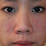 Dị ứng da mặt là tình trạng da bị kích ứng với các tác nhân bên ngoài