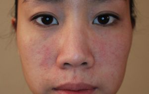 Dị ứng da mặt là tình trạng da bị kích ứng với các tác nhân bên ngoài