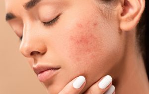 Dị ứng da mặt mẩn đỏ ngứa là phản ứng quá mức của hệ miễn dịch đối với các tác nhân gây bệnh
