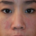 Dị ứng thời tiết ở mặt là tình trạng phổ biến, nhất là khi giao mùa