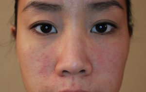 Dị ứng thời tiết ở mặt là tình trạng phổ biến, nhất là khi giao mùa