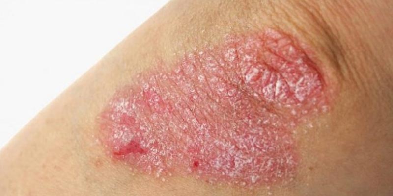 Cơ sở khoa học của phương pháp điều trị vẩy nến bằng diện chẩn