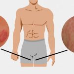 Hắc lào vùng kín gây ảnh hưởng nghiêm trọng đến sức khỏe, tâm lý người bệnh