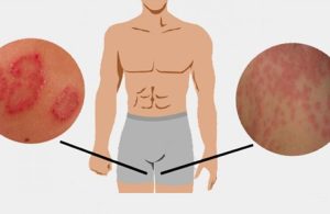 Hắc lào vùng kín gây ảnh hưởng nghiêm trọng đến sức khỏe, tâm lý người bệnh