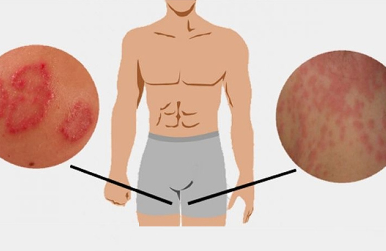 Hắc lào vùng kín gây ảnh hưởng nghiêm trọng đến sức khỏe, tâm lý người bệnh
