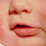 Bệnh hắc lào ở trẻ sơ sinh là gì? Bệnh có nguy hiểm không