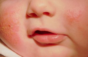 Bệnh hắc lào ở trẻ sơ sinh là gì? Bệnh có nguy hiểm không