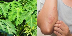 Chữa viêm da cơ địa bằng cách tắm lá có thực sự hiệu quả không?