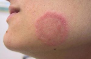 Vùng da bị tổn thương có màu hồng hoặc đỏ, có thể đậm hoặc nhạt tùy theo mức độ viêm nhiễm