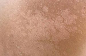 Bệnh lang ben có lây không?