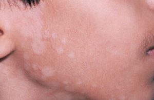 Lang ben khiến sắc tố da thay đổi, câu hỏi lang ben có ngứa không được nhiều người quan tâm