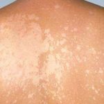 Bệnh lang ben có tự khỏi không là băn khoăn của nhiều người